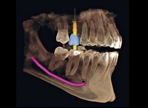 McLean dentist Guided Implant Technology