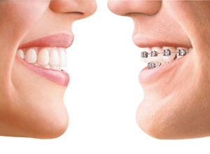 McLean dentist Invisalign / Orthodontic Braces