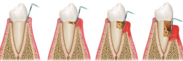 scaling and root planing mclean va