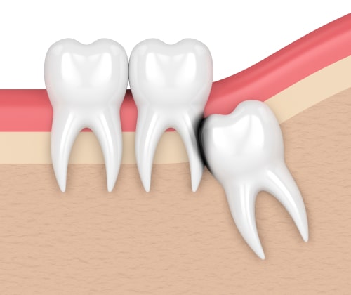 tooth extraction mclean va
