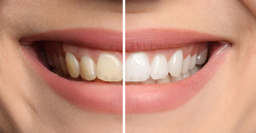 teeth whitening mclean va