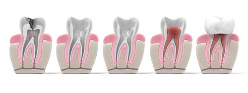 root canal treatment mclean va