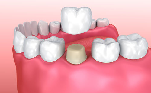 dental crown mclean va