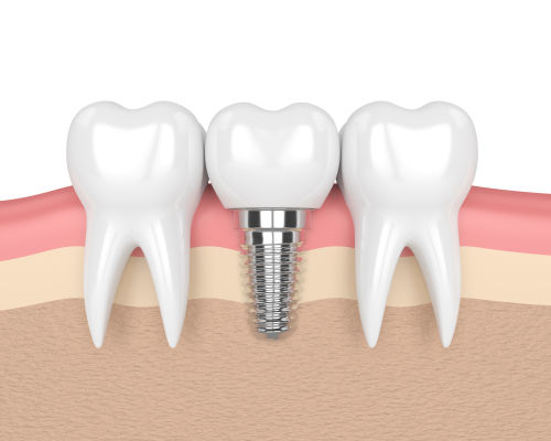 dental implant mclean va