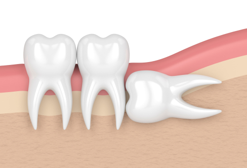 wisdom teeth mclean va