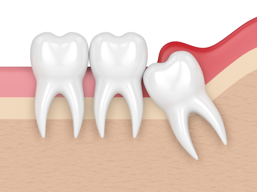 wisdom teeth mclean va