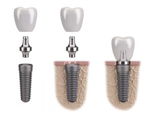 dental implants McLean VA
